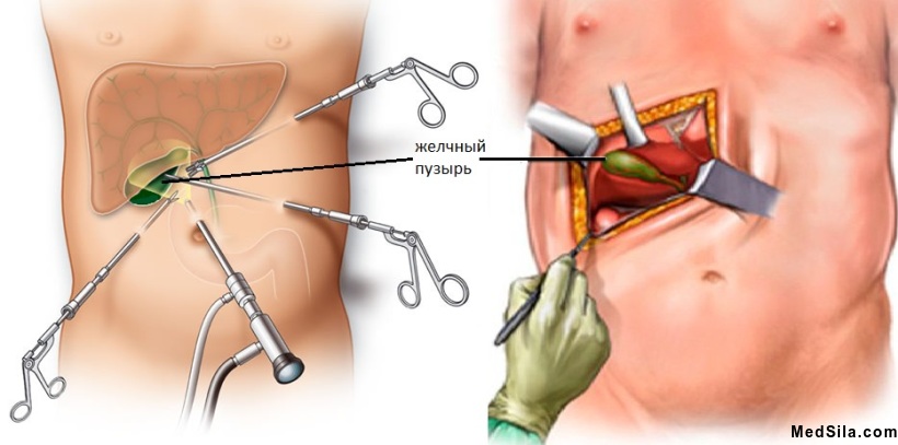 Виды холецистэктомий: лапароскопическая и открытая.