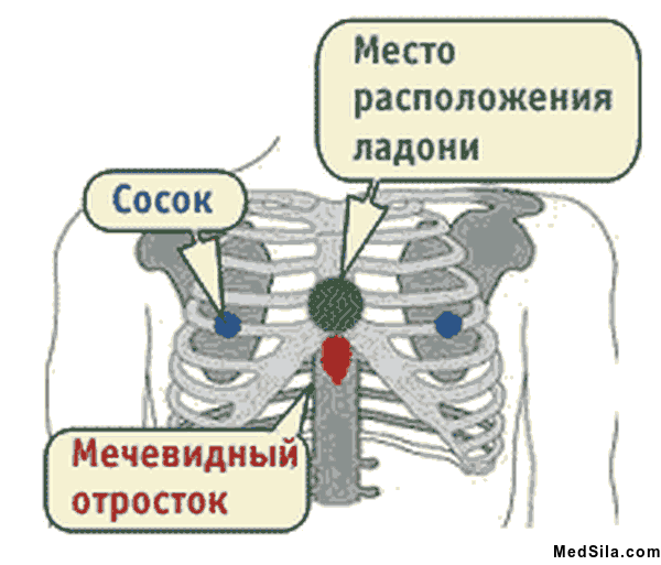 Место расположения ладони при СЛР